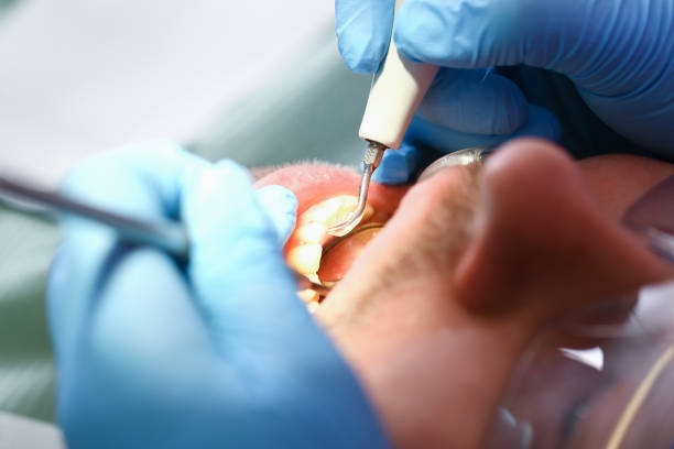Best Emergency Dentist for Knocked-Out Tooth in New Carlisle, OH